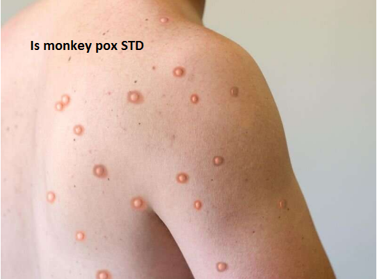 Is monkey pox an STD?